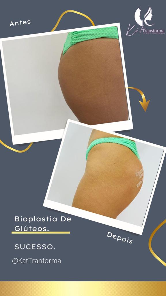 BIOPLASTIA DE GLÚTEOS (2)